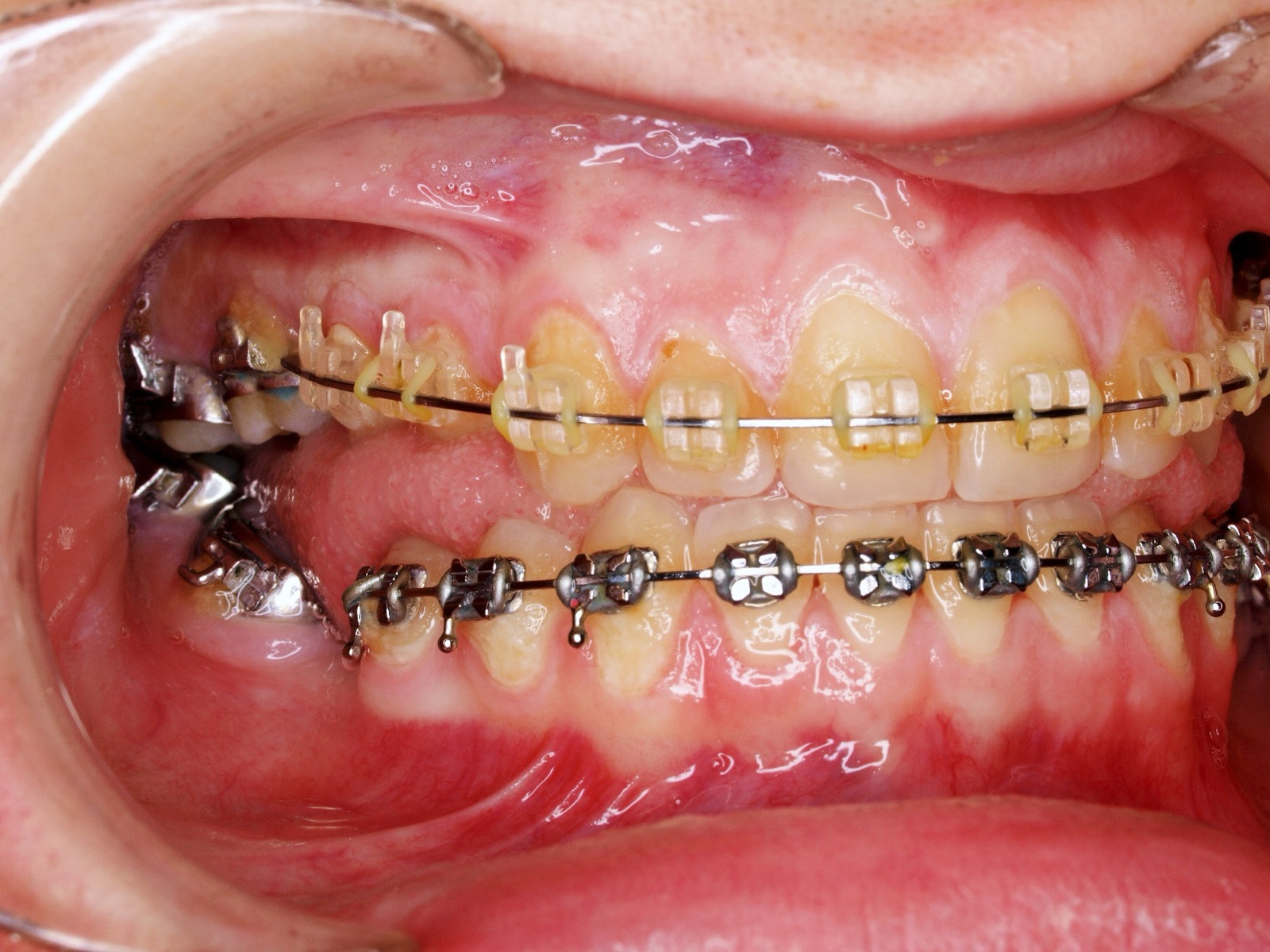 An open bite pattern visible during orthodontic evaluation