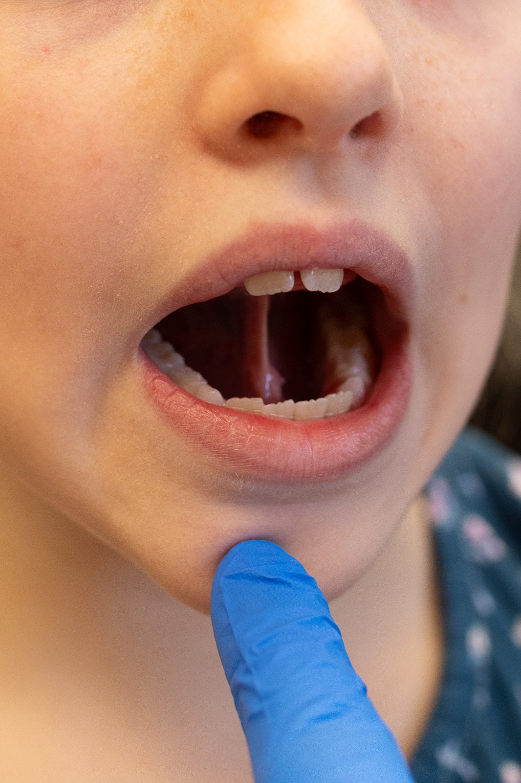 A tongue-suction exercise used in therapy