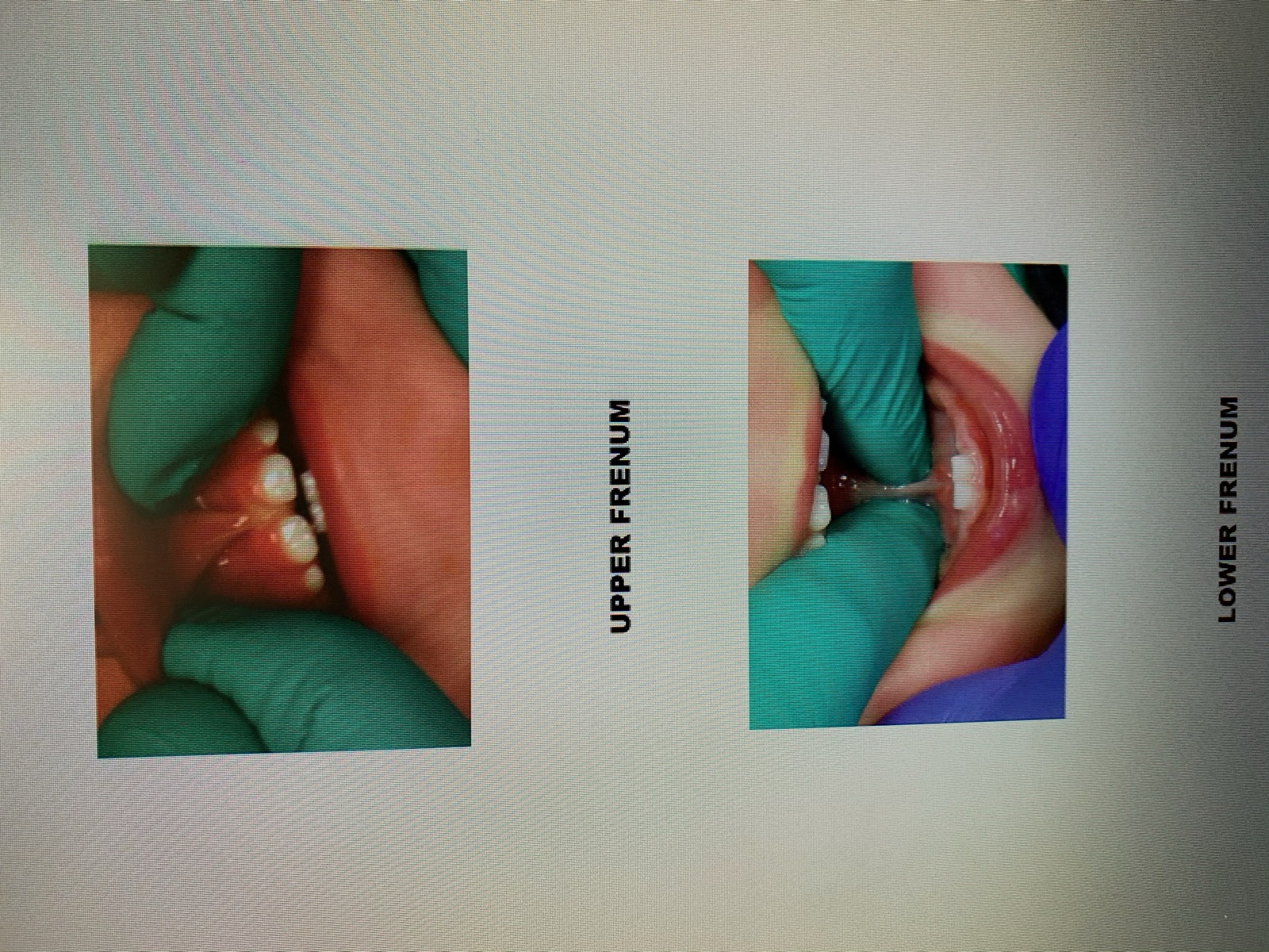 A young patient before beginning myofunctional therapy